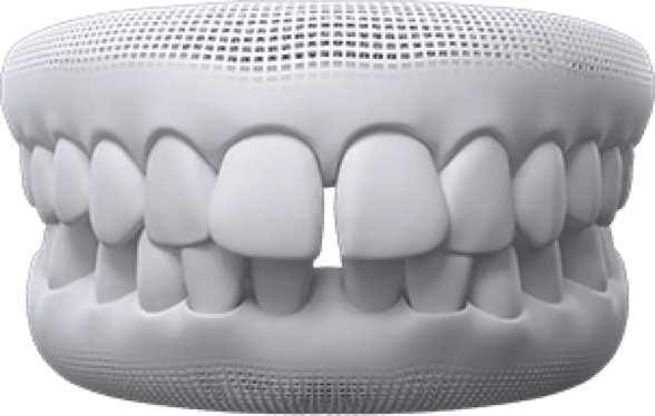 Gaps between teeth